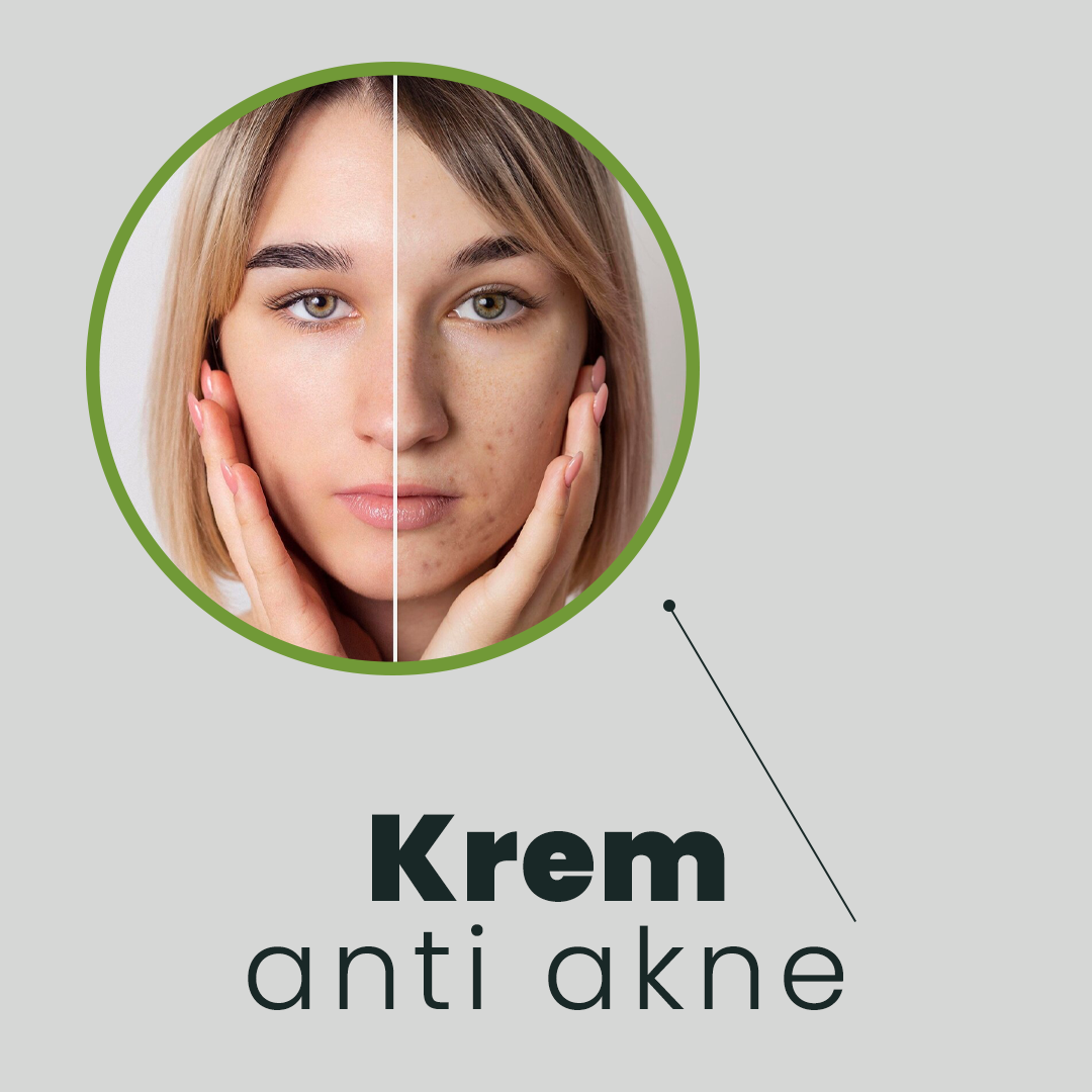 Anti-Acne Cream