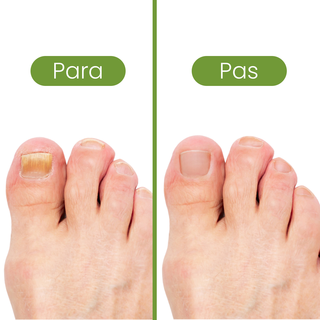 Krem për mykun e këmbëve